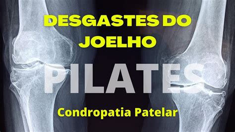 Joelho Condropatia Patelar Tratamento através do Pilates YouTube