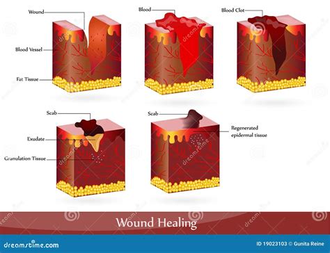 Wound Healing Process With Help Surgical Suture. Cartoon Vector ...