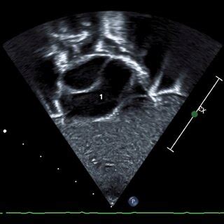 Fetal Echocardiogram Bicaval View Showing Ivc Color Doppler And Lsvc