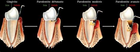 Symptôme Parodontite Êtes vous atteint d une Parodontite