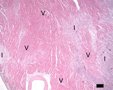 Myocardial Microinfarction After Coronary Microembolization In Swine