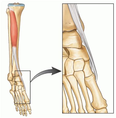 Anterior Tibialis Transfer For Residual Clubfoot Deformity Musculoskeletal Key