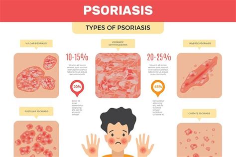 Psoriasis Infographic Human Skin Infection Psoriasis Diagnosis Vector