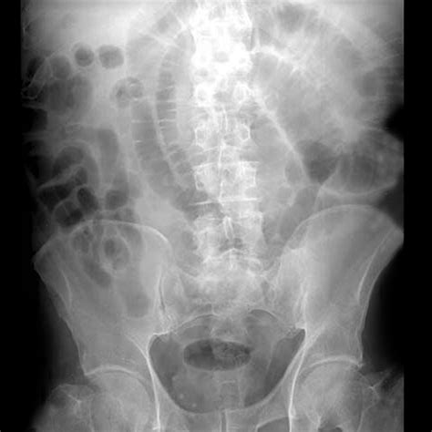 Year Old Male With A History Of An Appendectomy Presents With Nausea