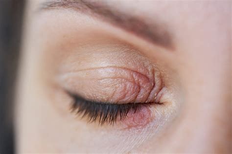 Eyelid Psoriasis Symptoms Treatment And More