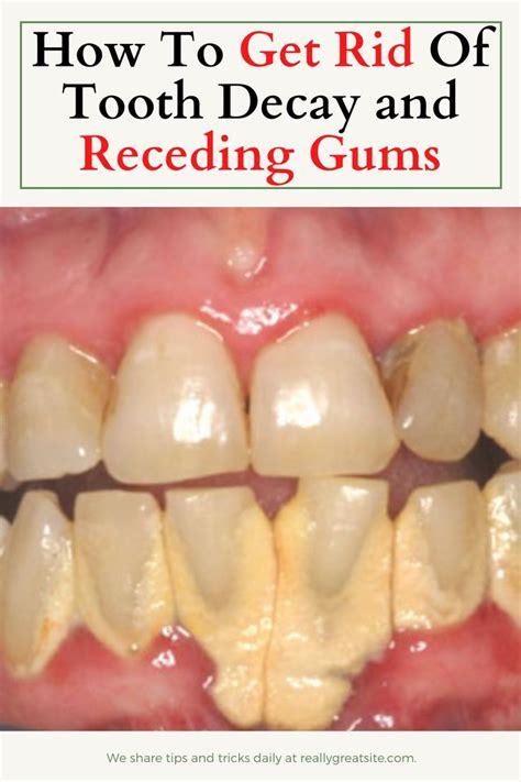 How To Get Rid Of Tooth Decay And Receding Gums Oral Health Receding