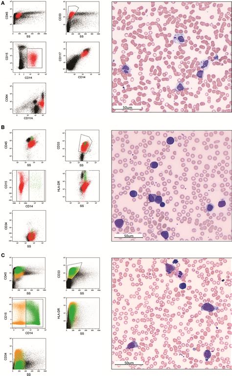 Frontiers | Diagnostic challenges in acute monoblastic/monocytic leukemia in children