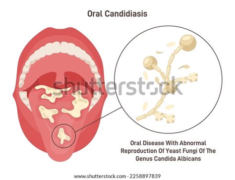 Oral Candidiasis Oral Yeast Infection Fungal Stock Vector Royalty Free