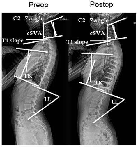 Jcm Free Full Text Incidence Of Cervical Kyphosis And Factors Associated With Improvement In