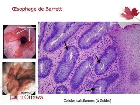 Ppt Conf Rence Anatomo Clinique Sophage De Barrett Carcinome