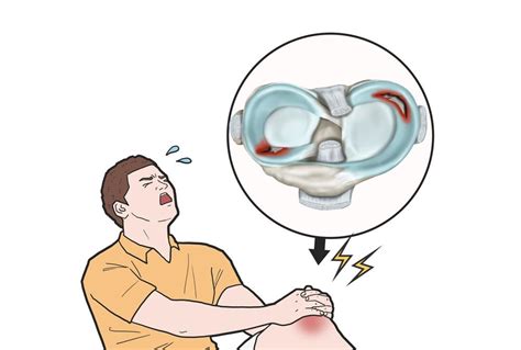 Most Important Factors in Recovery from Meniscal Tears Surgery