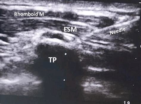 A Needle Penetrates The Muscles Until Hitting The Transverse Process Download Scientific