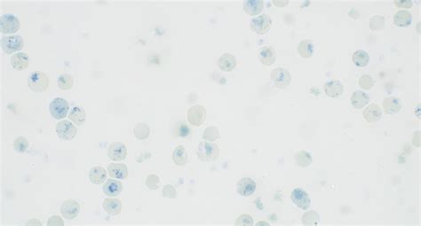 Peripheral blood smear of case 2. Methylene blue staining showing... | Download Scientific Diagram