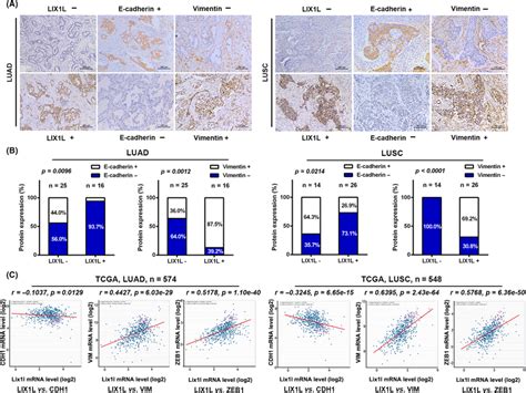 Lix L Expression Is Positively Correlated With Mesenchymal Markers In