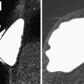 MRI Of A 54 Year Old Woman With A Ruptured Breast Implant Confirmed At