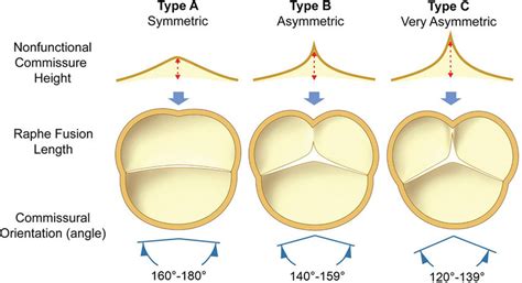 Repair Oriented Bicuspid Aortic Valve Classification According To