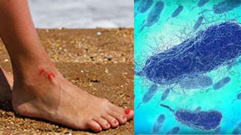 Vibrio Vulnificus