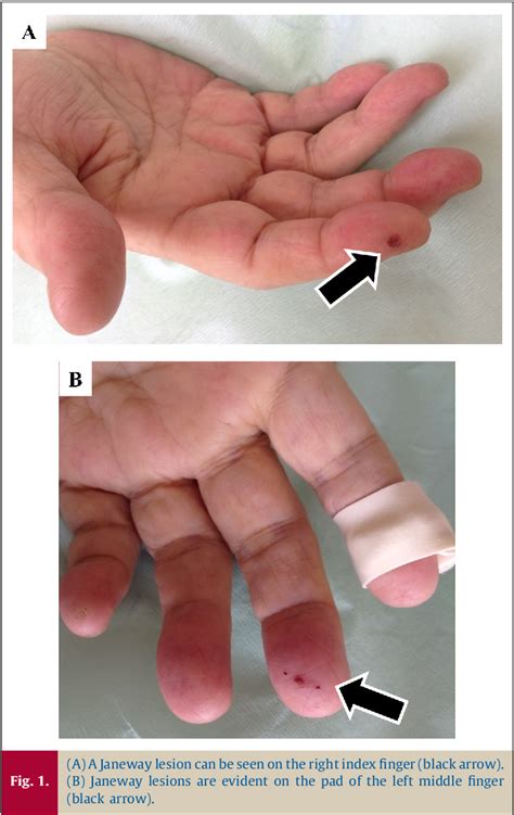 Figure 1 From Rapid Diagnosis Of Prosthetic Valve Endocarditis From Janeway Lesions In A