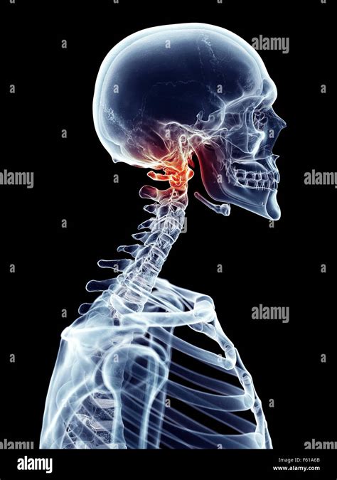 Medically Accurate Illustration Painful Cervical Spine Stock Photo