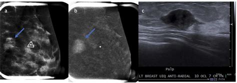 Contrast Enhanced Mammography For Women With Palpable Breast