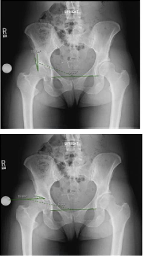 Anterior Posterior Pelvis Radiograph In A Patient With Hip Dysplasia