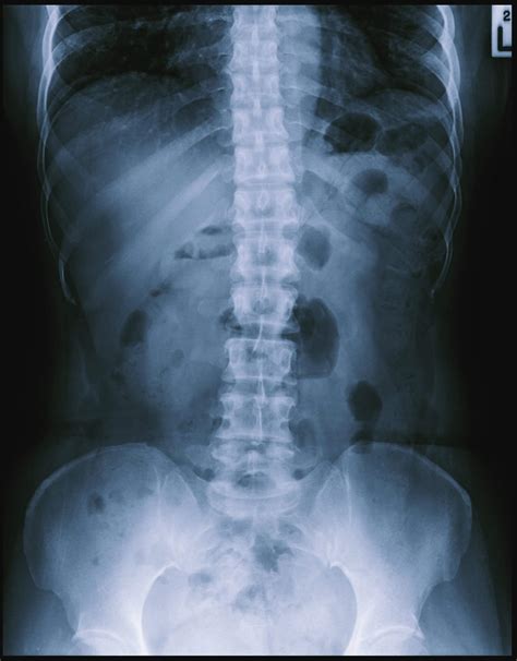 Abdominal Radiograph Interpretation Oscestop Osce Learning