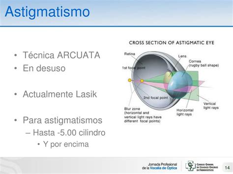 PPT Balance y futuro de la Cirugía refractiva PowerPoint