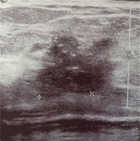 Ultrasound Abdomen Legend Spiculated Hypoechoic Lesion 25 × 22 × Download Scientific