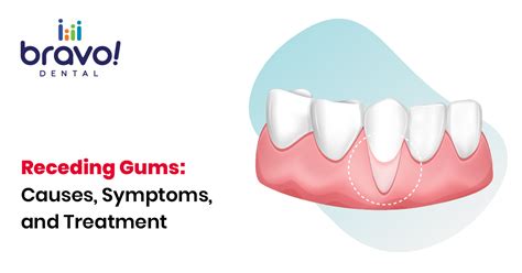 Receding Gums Causes Symptoms And Treatment Bravo Dental