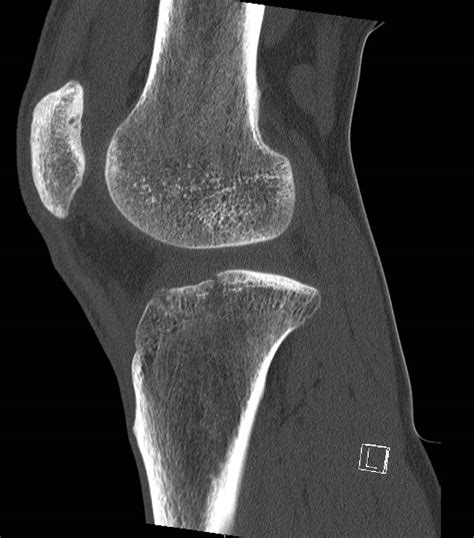 Knee Lipohaemarthrosis The Emergency Physio