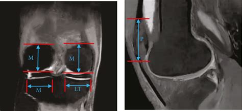 Figure 1 From Mri Semi Quantitative Evaluation Of Clinical Features Of