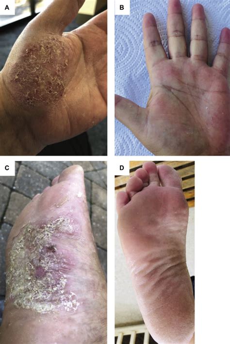 Successful Treatment Of Refractory Tumor Necrosis Factor Inhibitor