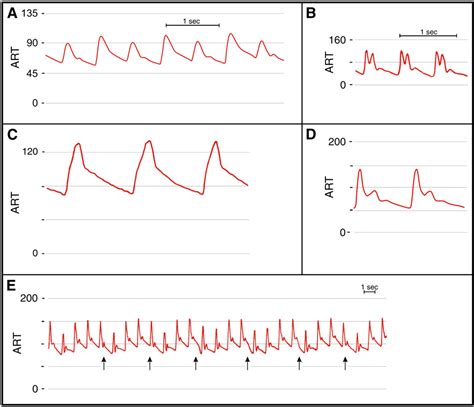 Cvp Central Venous Pressure Monitoring