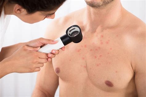 Chest Acne 8 Causes And How To Get Rid Of It