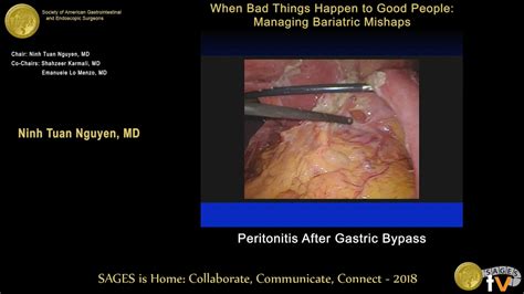 Laparoscopic Graham Patch Repair Of A Perforated Marginal Ulcer 6 Yrs