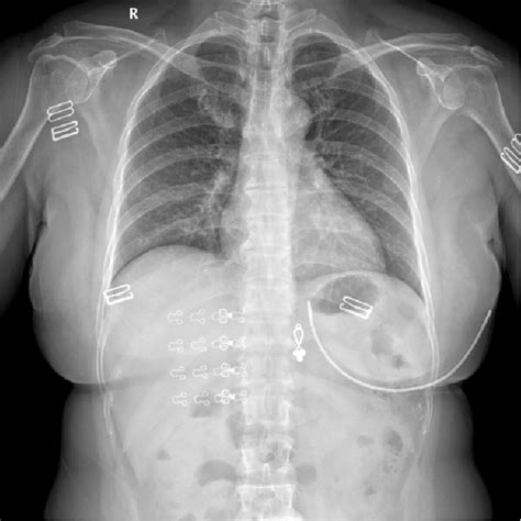 Chest X Ray Pneumonia Vs Bronchitis