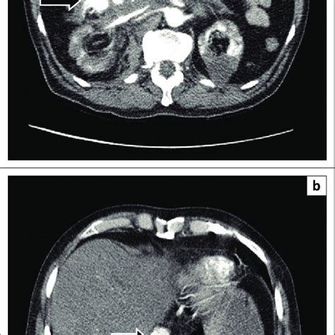 Axial Contrast Enhanced Computed Tomography Showing A Large Infrarenal