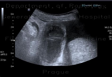 Emphysematous Cholecystitis Ultrasound