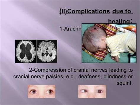 Complications of meningitis in children