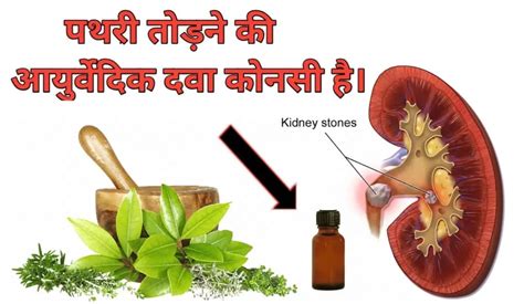 गुर्दे की पथरी का आयुर्वेदिक ईलाज Home Remedies Doctor