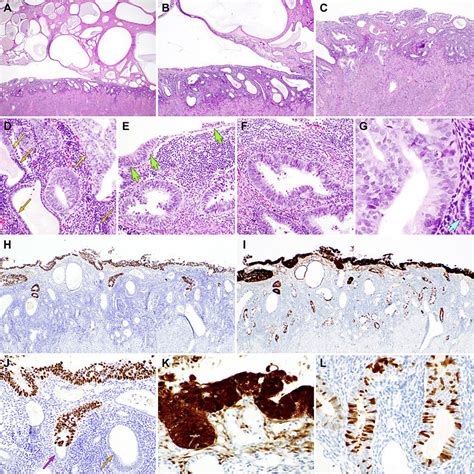 Histological Features And Immunostaining Results Of The Hysterectomy