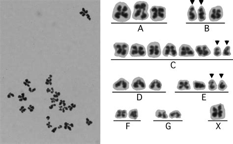 Metaphase Ii Karyoplast Transfer From Human In Vitro Matured Oocytes To