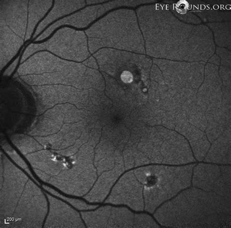 Macular Hole Full Thickness Extrafoveal Eccentric