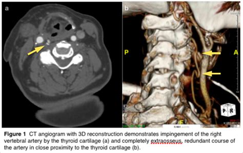 Vertebral Artery Occlusion