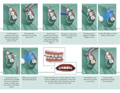 Composite Cavity Filling | Cavity filling, Cavities, Filling