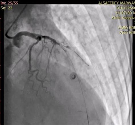 Figure3a: mid LAD subtotally occluded stent in LAD Involved ostial... | Download Scientific Diagram