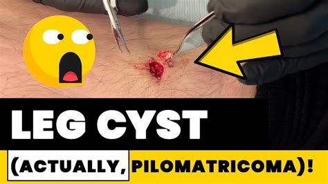 Leg Cyst Actually Pilomatricoma Youtube