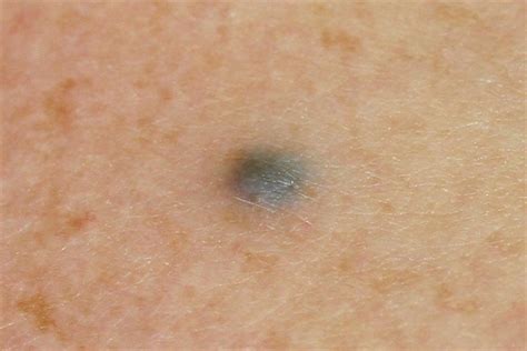 What Is Blue Rubber Bleb Nevus Syndrome