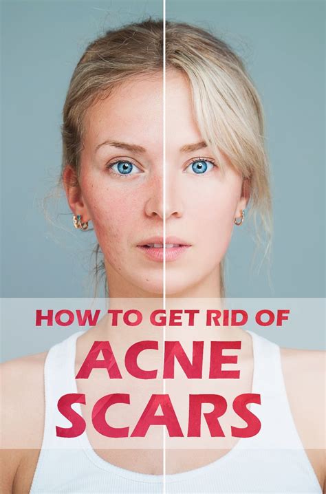 Six Tips For How To Get Rid Of Adult Acne Forever Artofit