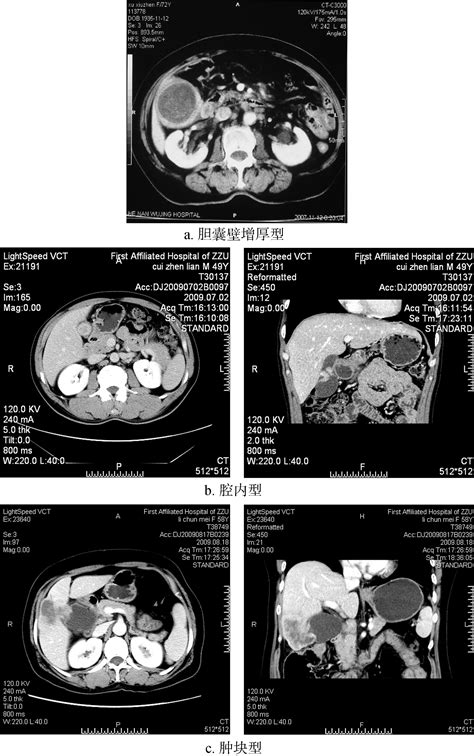 胆囊癌 名医解读ct 医学